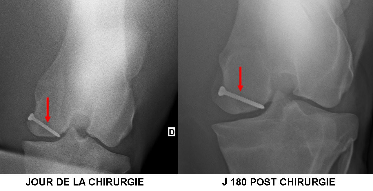 Kyste Osseux Sous Chondral Du Grasset Femur Mise En Place D Une Vis Trans Kystique Ancienne Technique La Clinique Du Cheval